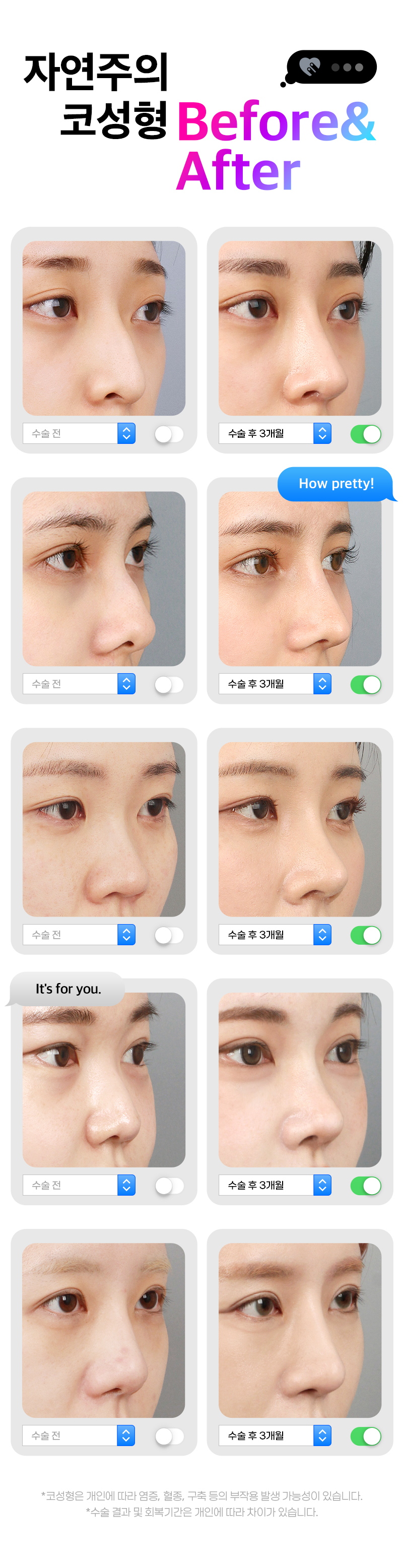 자연주의 코성형 Before & After