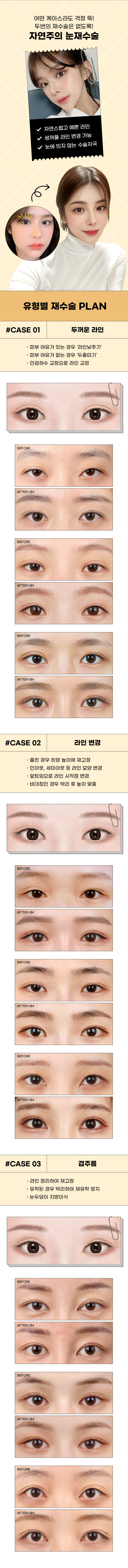 자연주의 눈성형