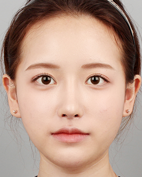 CASE 01 수술 후 정면