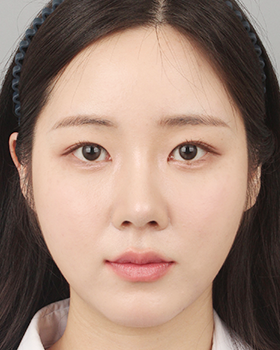 CASE 02 수술 후 정면