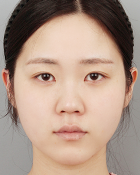 CASE 02 수술 전 정면