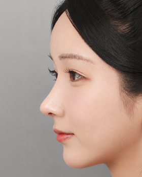 CASE 03 수술 후 측면