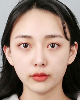 CASE 04 수술 후 정면