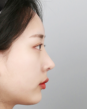 CASE 04 수술 후 측면