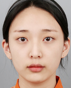 CASE 04 수술 전 정면