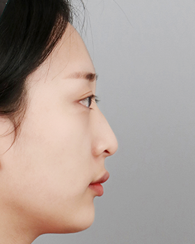 CASE 04 수술 전 측면