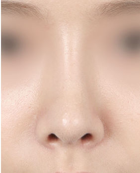 수술 후 3개월