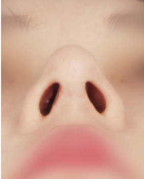 수술 후 3개월