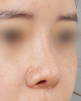 수술 후 3개월